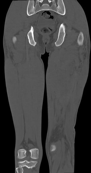 File:Chronic osteomyelitis (with sequestrum) (Radiopaedia 74813-85822 Coronal non-contrast 39).jpg