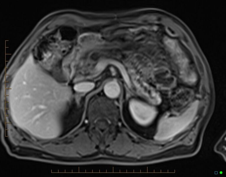 File:Chronic pancreatitis (Radiopaedia 17014-16716 Axial T1 C+ fat sat 25).jpg