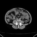 Chronic pancreatitis (Radiopaedia 23132-23172 Axial non-contrast 50).jpg