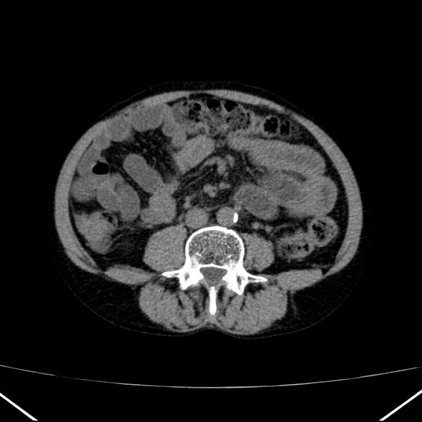 File:Chronic pancreatitis (Radiopaedia 23132-23172 Axial non-contrast 50).jpg