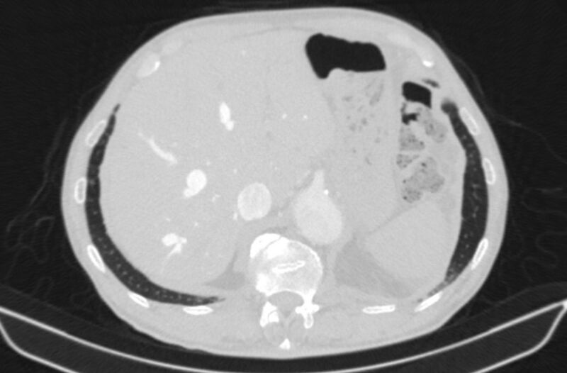 File:Chronic pulmonary embolism (Radiopaedia 91241-108843 Axial lung window 88).jpg