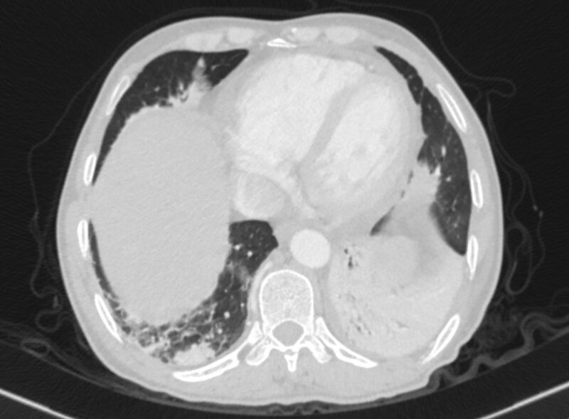File:Chronic pulmonary embolism with bubbly consolidation (Radiopaedia 91248-108850 Axial lung window 123).jpg