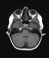 Chronic reactive multifocal osteomyelitis (CRMO) - mandible (Radiopaedia 56405-63069 Axial T1 23).jpg