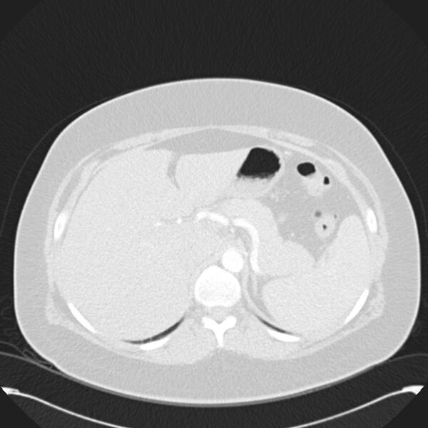 File:Chronic thromboembolic pulmonary hypertension (CTEPH) (Radiopaedia 74597-85531 Axial lung window 55).jpg