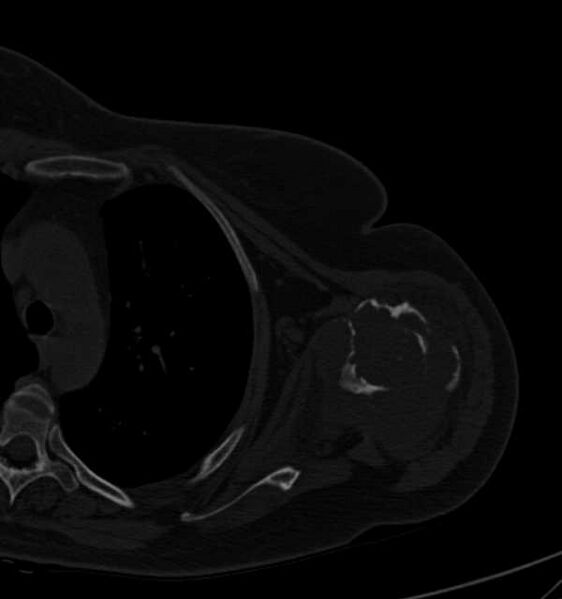 File:Clear cell chondrosarcoma - humerus (Radiopaedia 63104-71612 Axial bone window 57).jpg