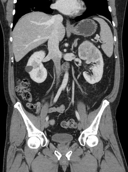 File:Clear cell renal cell carcinoma (Radiopaedia 61449-69393 F 17).jpg