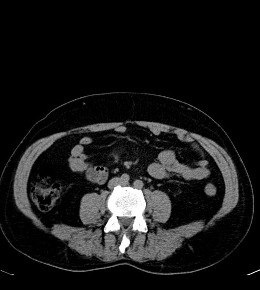 File:Clear cell renal cell carcinoma (Radiopaedia 85006-100539 Axial non-contrast 52).jpg