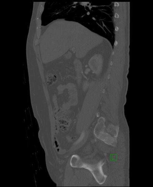File:Clear cell renal cell carcinoma (Radiopaedia 85006-100539 Sagittal bone window 40).jpg