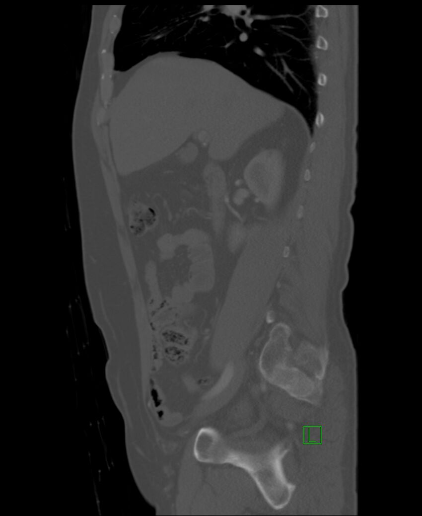Clear cell renal cell carcinoma (Radiopaedia 85006-100539 Sagittal bone window 40).jpg