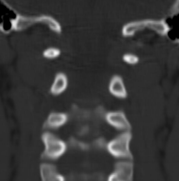 File:Cleft of the posterior arch of C1 mimicking fracture (Radiopaedia 40201-42721 Coronal bone window 10).jpg