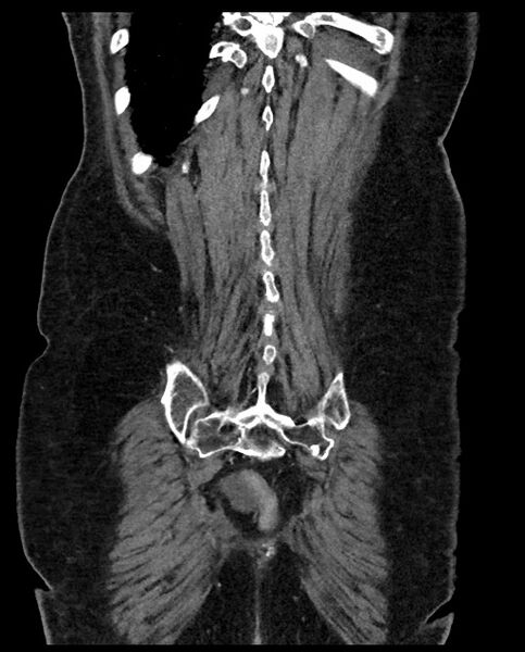 File:Closed loop small bowel obstruction - adhesions (Radiopaedia 59269-66611 B 110).jpg