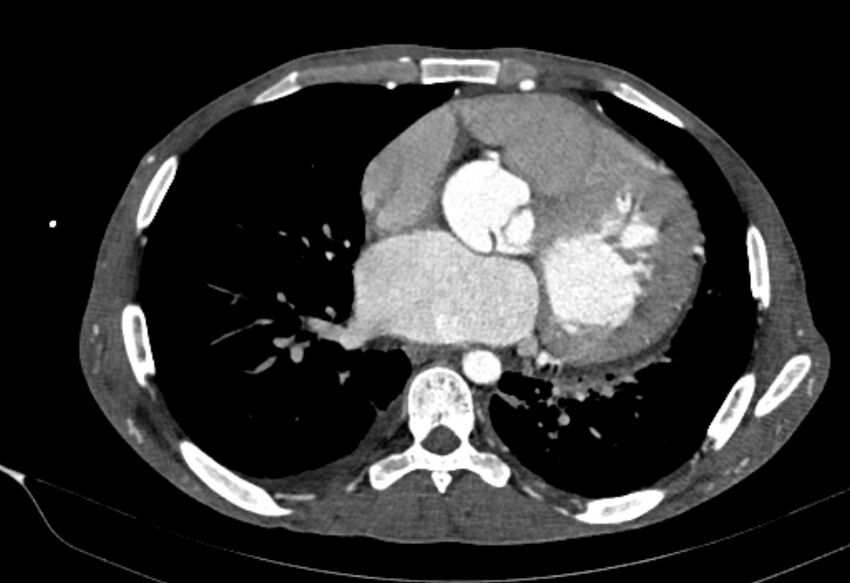 Coarctation of aorta with aortic valve stenosis (Radiopaedia 70463-80574 A 123).jpg