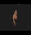 Coarctation of the aorta (Radiopaedia 43373-46729 3D reconstruction 35).jpg