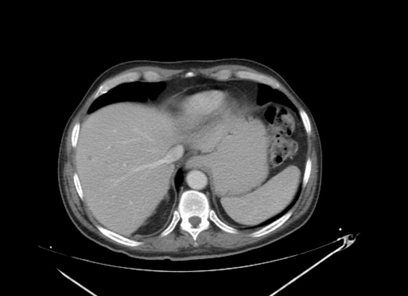 File:Colon cancer mimicking renal cell carcinoma (Radiopaedia 28986-29335 C 9).jpg