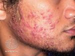 Facial acne (DermNet NZ acne-acne-face-acne-face-29).jpg