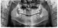 Impacted wisdom tooth (OPG) (Radiopaedia 55220).png