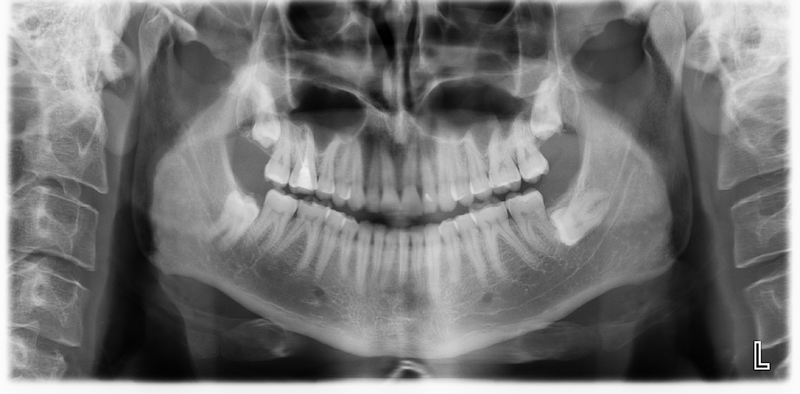 File:Impacted wisdom tooth (OPG) (Radiopaedia 55220).png