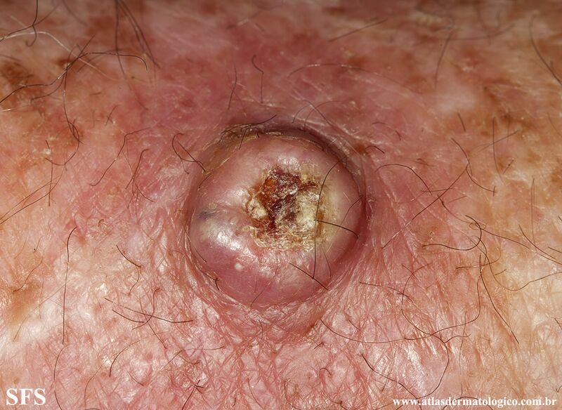 File:Keratoacanthoma (Dermatology Atlas 73).jpg