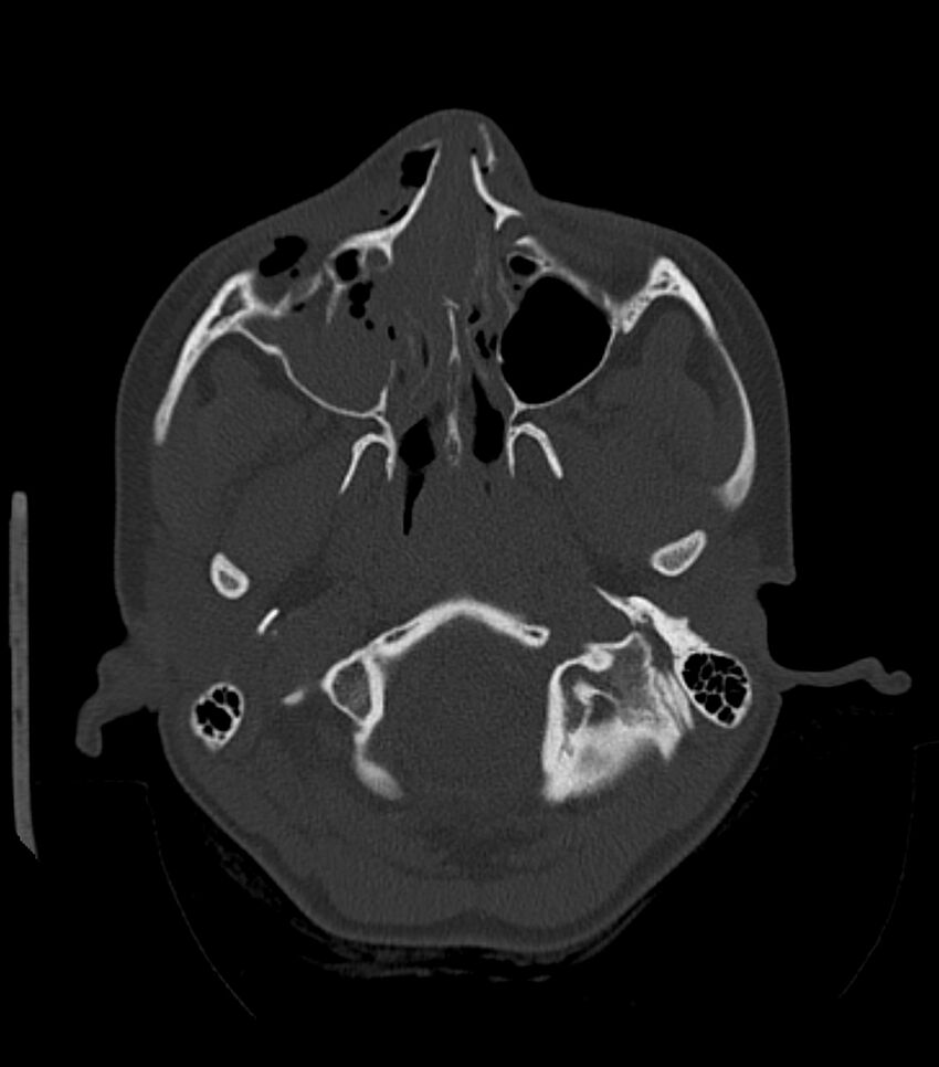 Nasoorbitoethmoid fracture (Radiopaedia 90044-107205 Axial bone window 68).jpg
