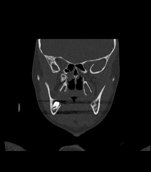 File:Nasoorbitoethmoid fracture (Radiopaedia 90044-107205 Coronal bone window 64).jpg