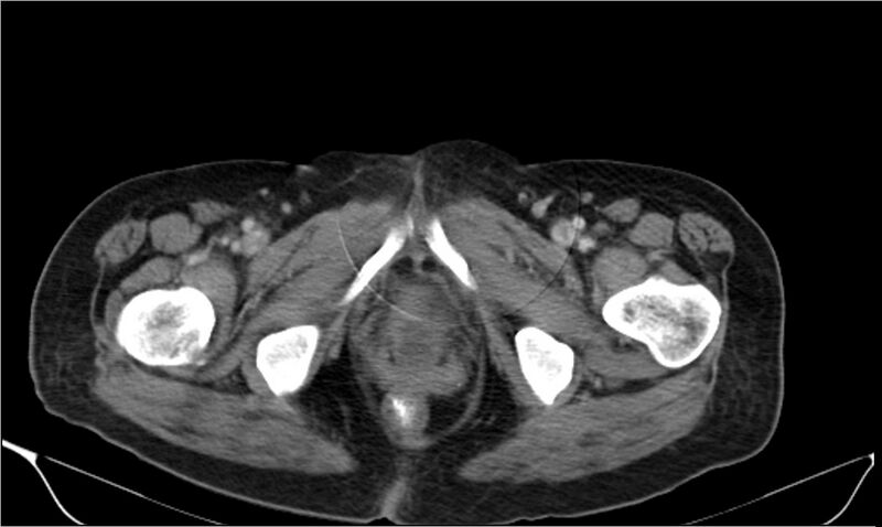 File:Necrotizing pancreatitis (Radiopaedia 20595-20495 A 48).jpg