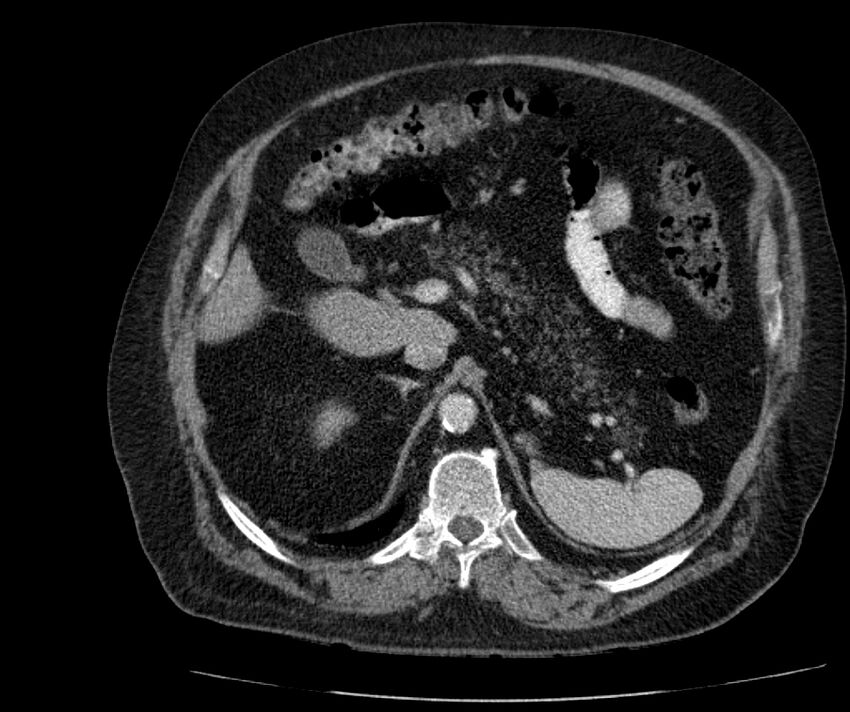 Nephroptosis with inguinal hernia containing perirenal fat (Radiopaedia 56632-63391 C 102).jpg