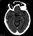 Neurocysticercosis (Radiopaedia 7773-8596 C+ delayed 3).jpg