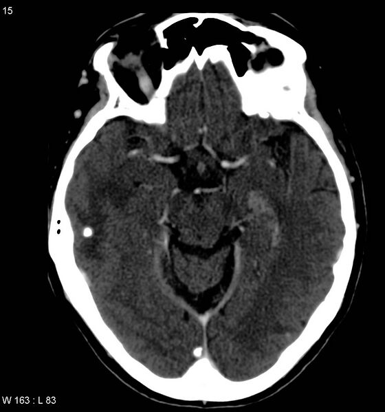 File:Neurocysticercosis (Radiopaedia 7773-8596 C+ delayed 3).jpg