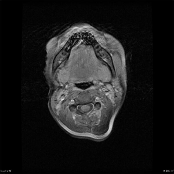 File:Neurofibromatosis type 1 (Radiopaedia 22541-22564 Axial T1 C+ fat sat 8).jpg