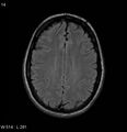Neurosarcoidosis (Radiopaedia 10930-17204 Axial FLAIR 14).jpg