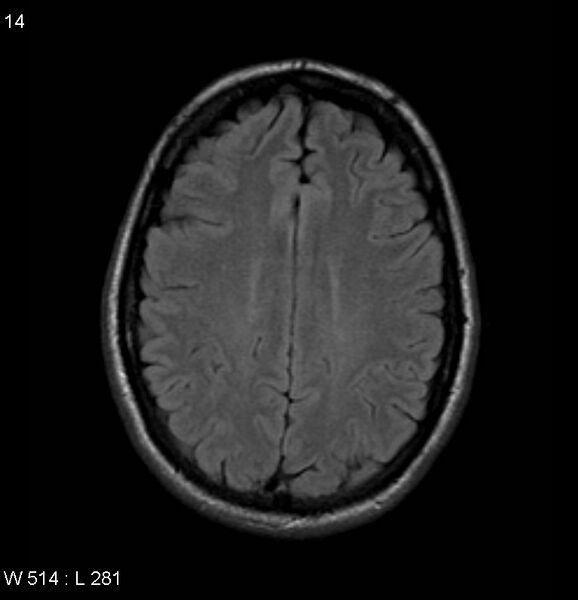 File:Neurosarcoidosis (Radiopaedia 10930-17204 Axial FLAIR 14).jpg