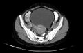 Non-puerperal uterine inversion (Radiopaedia 78343-91094 A 4).jpg
