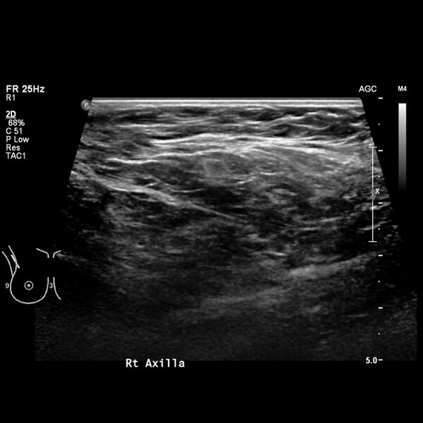 File:Normal breast mammography (tomosynthesis) and ultrasound (Radiopaedia 65325-74354 Right breast 19).jpeg