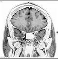 Normal coronal brain (Radiopaedia 6676-7910 B 11).jpg