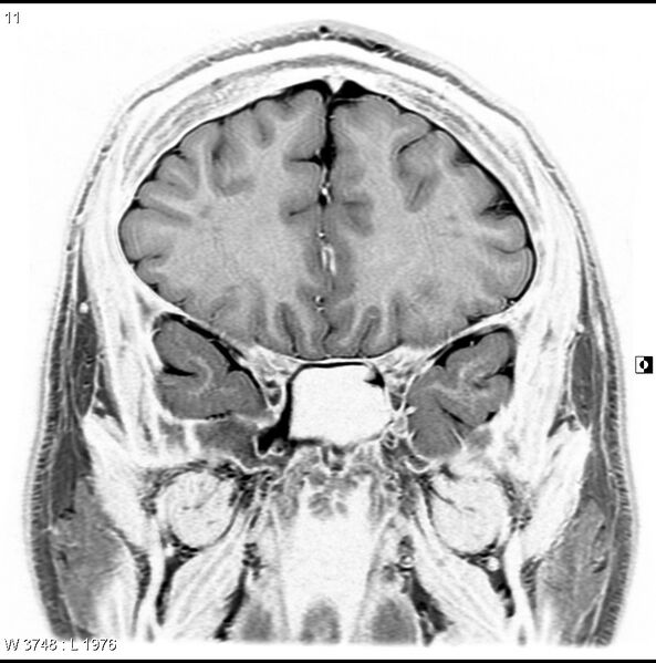 File:Normal coronal brain (Radiopaedia 6676-7910 B 11).jpg