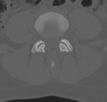 Normal lumbar spine CT (Radiopaedia 46533-50986 Axial bone window 53).png