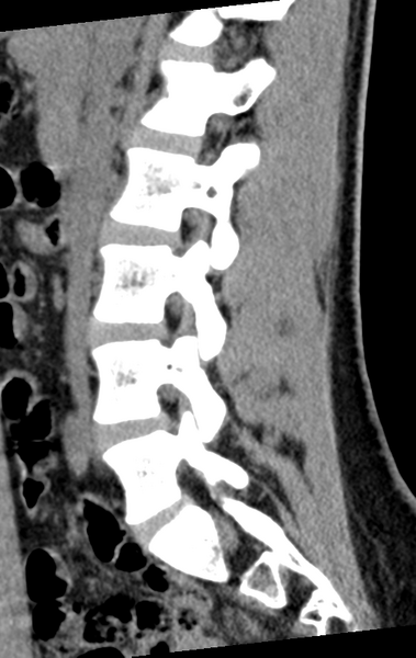 File:Normal lumbar spine CT (Radiopaedia 46533-50986 C 62).png
