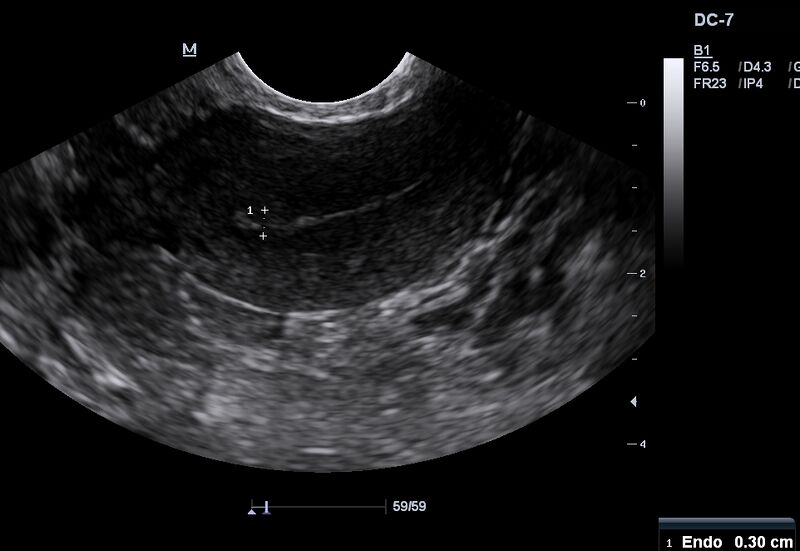 File:Normal menstrual phase endometrium (Radiopaedia 30611).JPG