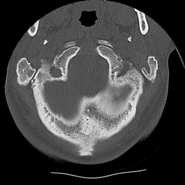 File:Normal trauma spine imaging (Radiopaedia 31753-32686 Axial bone window 3).jpg