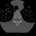 Normal trauma spine imaging (age 16) (Radiopaedia 45335-49358 Axial bone window 101).jpg