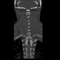 Occipital condyle fracture (Radiopaedia 31755-32691 Coronal bone window 25).jpg