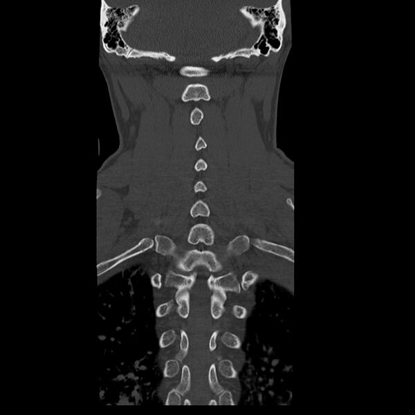 File:Occipital condyle fracture (Radiopaedia 31755-32691 Coronal bone window 25).jpg