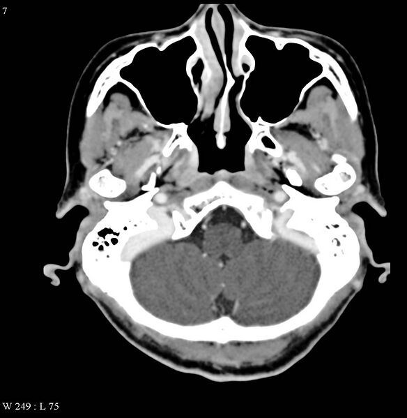 File:Occipital condyle metastasis - into mastoid (Radiopaedia 5424-7177 B 7).jpg