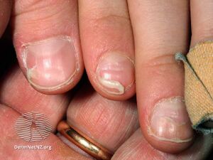 Onychomadesis following hand foot and mouth disease (DermNet NZ enteronail5).jpg