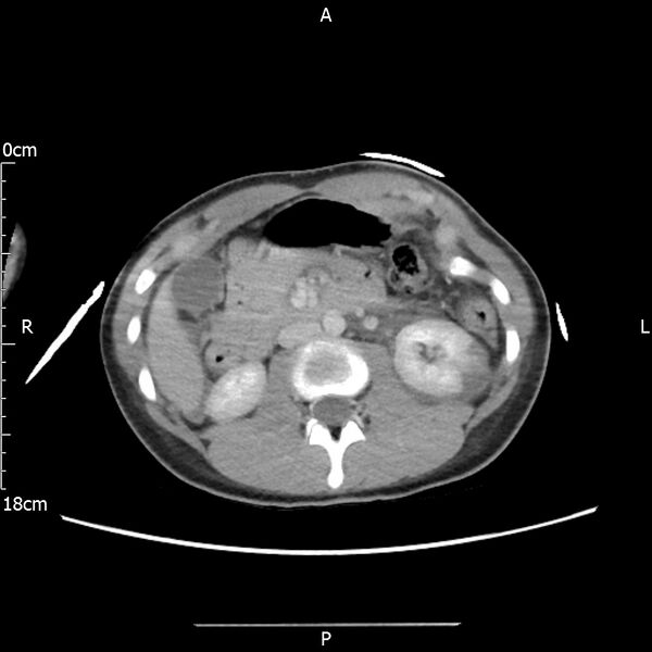 File:AAST grade IV kidney injury with CEUS follow-up (Radiopaedia 72353-82877 Axial C+ portal venous phase 30).jpg