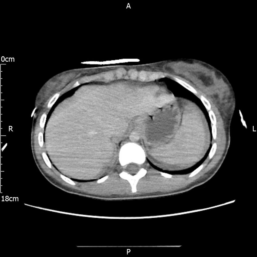 AAST grade IV kidney injury with CEUS follow-up (Radiopaedia 72353-82877 Axial C+ portal venous phase 9).jpg