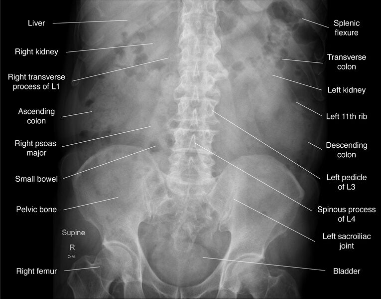 File:Abdomen x-ray (annotated) (Radiopaedia 56646-63430 Frontal 1).jpg