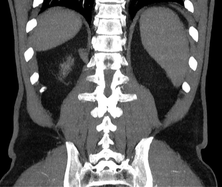 File:Abdominal aortic aneurysm (Radiopaedia 22421-22458 C 39).jpg
