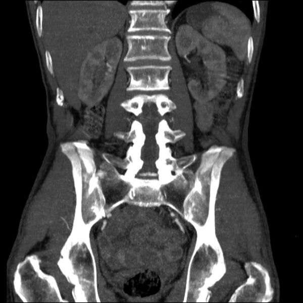 File:Abdominal aortic aneurysm (Radiopaedia 23703-23856 Coronal C+ arterial phase 23).jpg
