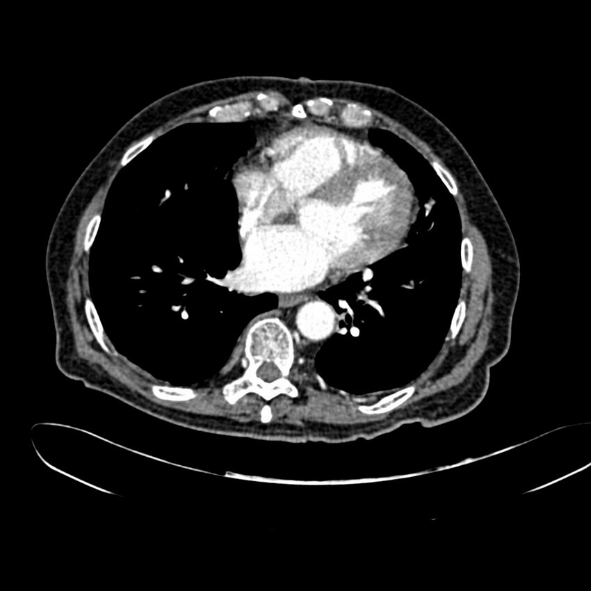 Abdominal aortic aneurysm (Radiopaedia 75131-86203 Axial C+ arterial phase 1).jpg